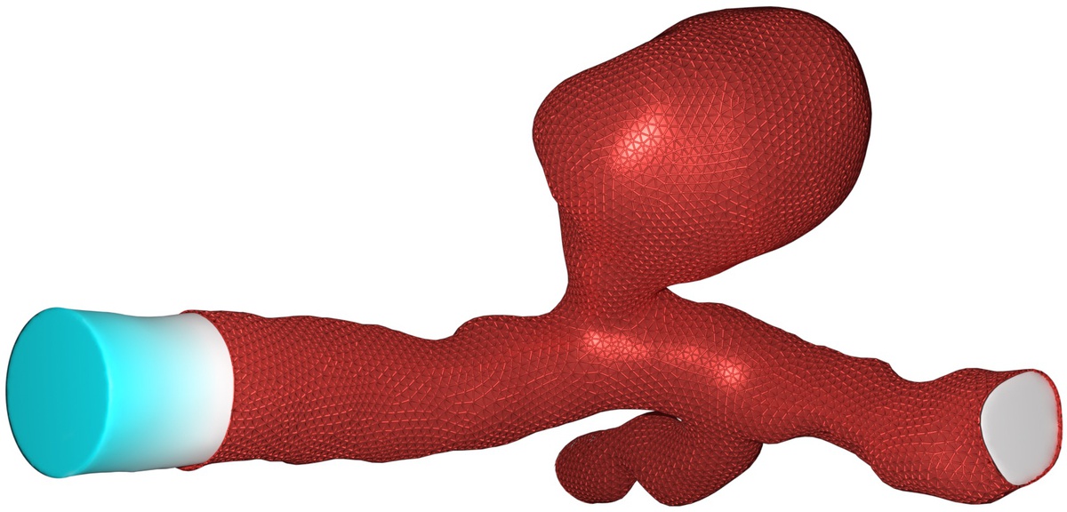 New publication on the modeling of cerebral aneurysm treatment