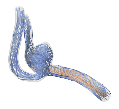 Fluid flow inside an aneurysm Streamlines of the fluid flow inside a patient-specific aneurysm geometry
