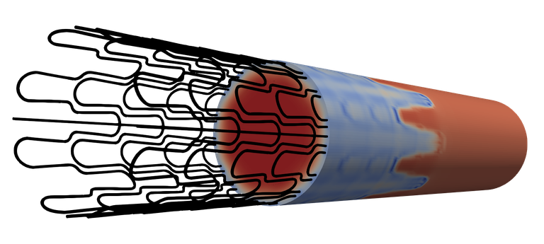 stent.png